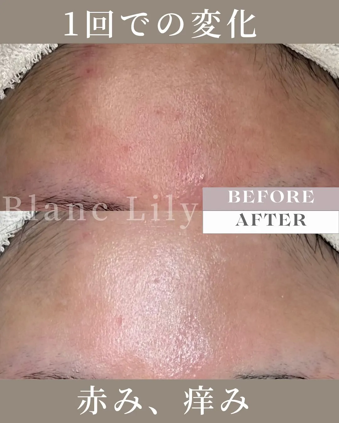 ミルクピーリング1回