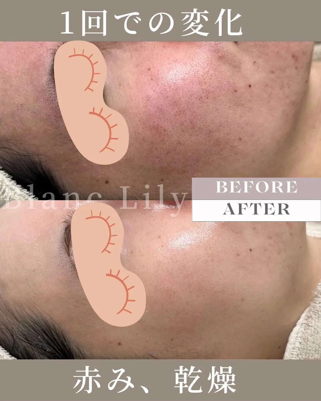 ミルクピーリング1回