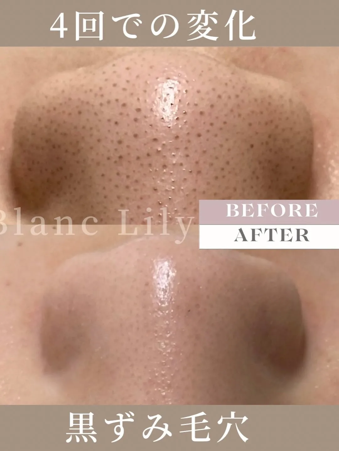 #薬院ハーブピーリング##薬院エステサロン#薬院クリスティー...