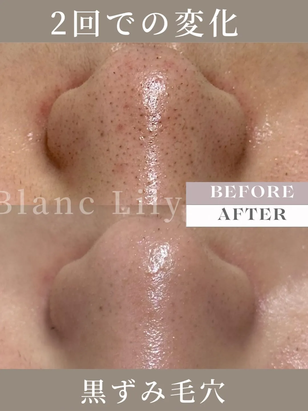 #薬院ハーブピーリング##薬院エステサロン#薬院クリスティー...