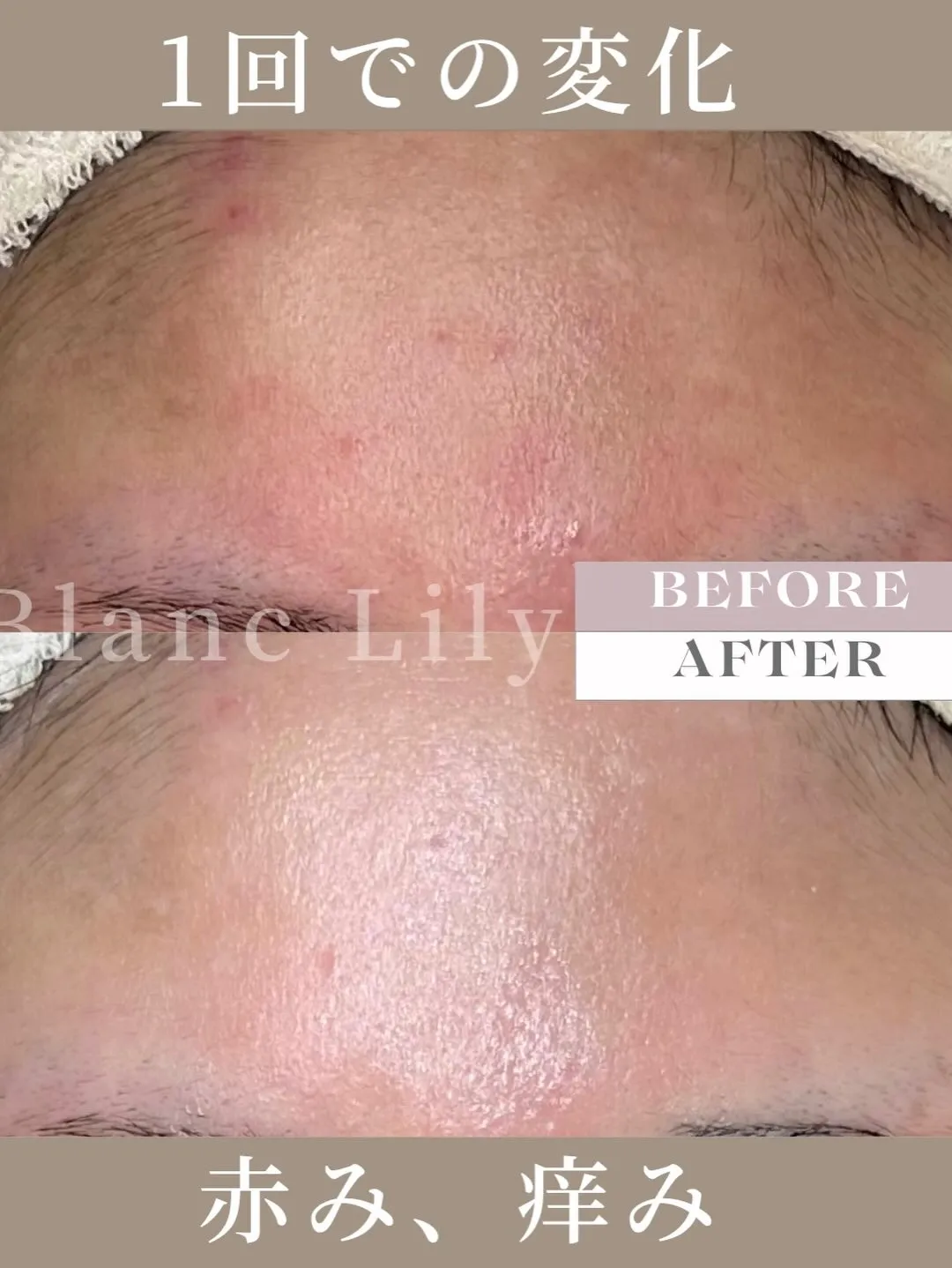 #薬院ハーブピーリング##薬院エステサロン#薬院クリスティー...