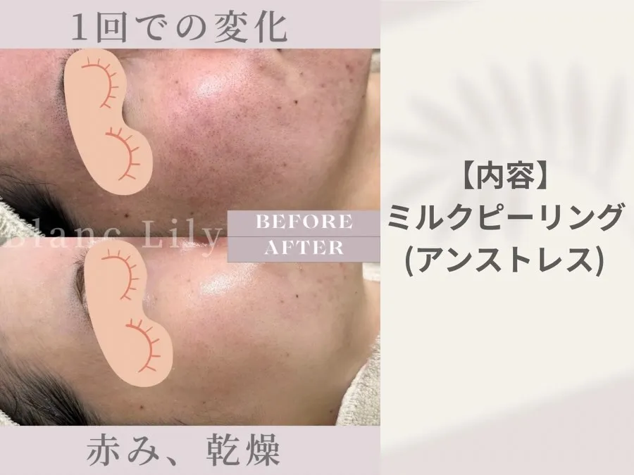 #薬院ハーブピーリング#薬院肌質改善#薬院ニキビ#薬院毛穴ケ...