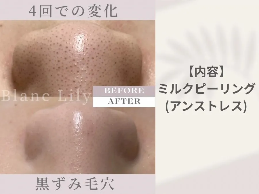 #薬院ハーブピーリング#薬院肌質改善#薬院ニキビ#薬院毛穴ケ...