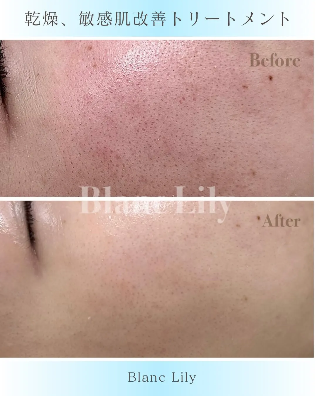 花粉の時期の肌荒れを「仕方ない」と諦めていませんか？