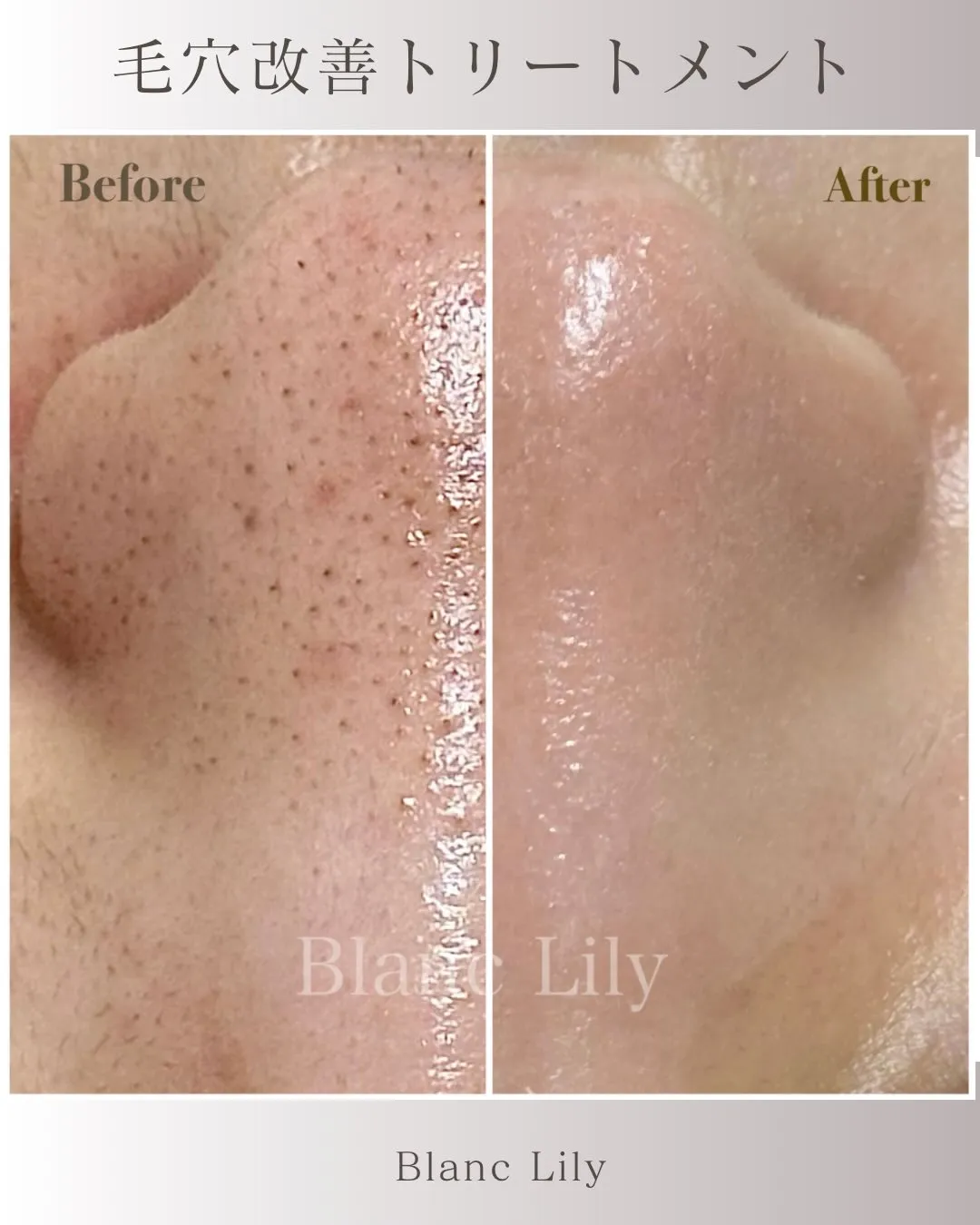 毛穴改善トリートメント★ハーブピーリング×EXヒト幹細胞培養...