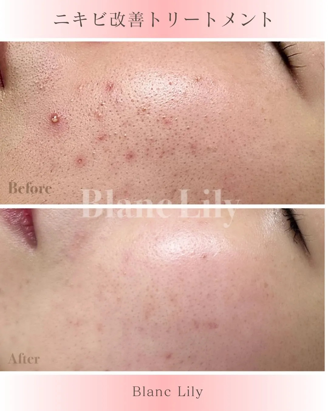 ニキビができるたびに